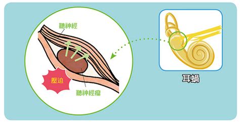 左邊耳鳴|耳鳴原因有3種，一直耳鳴怎麼辦？舒緩耳鳴症狀醫師。